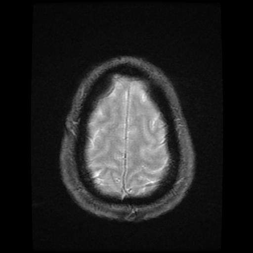 File:Cerebellar hemangioblastoma (Radiopaedia 88055-104622 Axial Gradient Echo 18).jpg