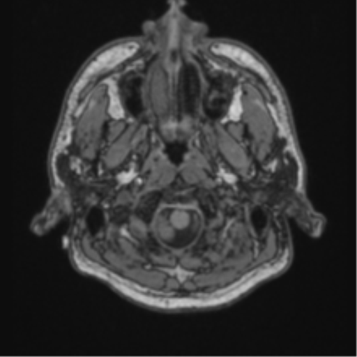 Cerebellar hemangioblastomas and pituitary adenoma (Radiopaedia 85490-101176 Axial T1 5).png