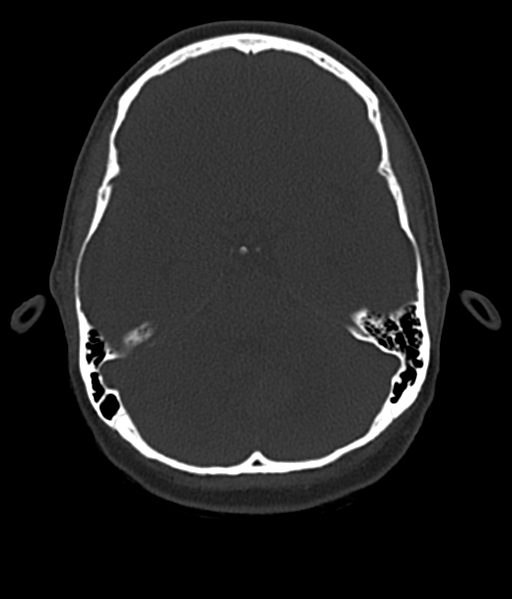 File:Cerebellar metastases - colorectal adenocarcinoma (Radiopaedia 40947-43652 AX Bone C- 2.0 MPR 19).png