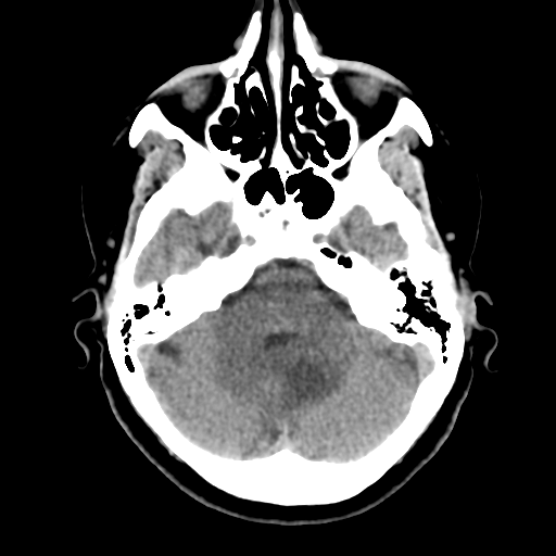 Cerebellar metastasis (cystic appearance) (Radiopaedia 41395-44258 Axial non-contrast 16).png