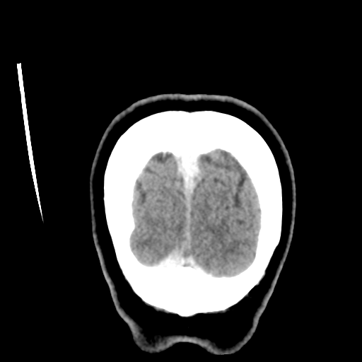 Cerebellar metastasis (cystic appearance) (Radiopaedia 41395-44258 D 57).png