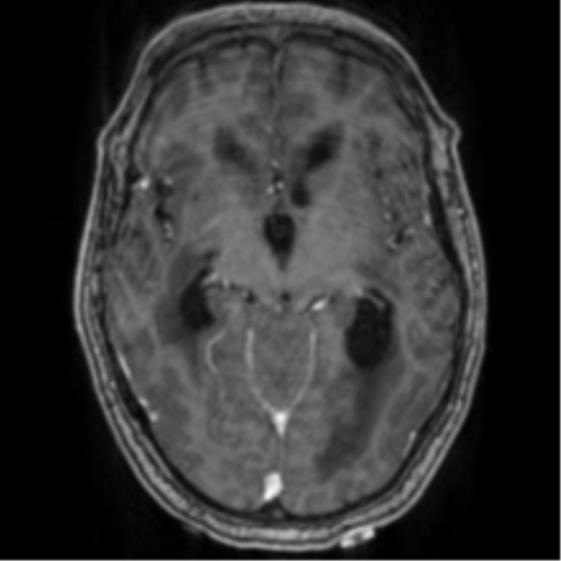 File:Cerebellar metastasis from lung adenocarcinoma (Radiopaedia 86690-102829 Axial T1 C+ 37).png