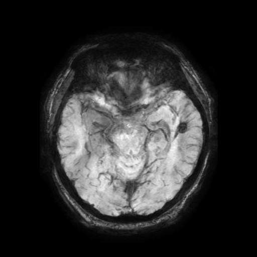 Cerebellar metastasis of pulmonary adenocarcinoma, cavernous venous malformation, and developmental venous anomaly (Radiopaedia 85827-101661 Axial SWI 43).jpg