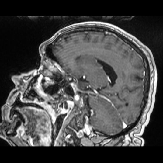 Cerebellar metastasis of pulmonary adenocarcinoma, cavernous venous malformation, and developmental venous anomaly (Radiopaedia 85827-101661 Sagittal T1 C+ 58).jpg