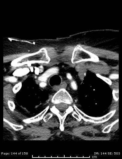 Cerebellar strokes due to intracranial giant cell arteritis (Radiopaedia 68799-78510 CT angiogram 144).jpg