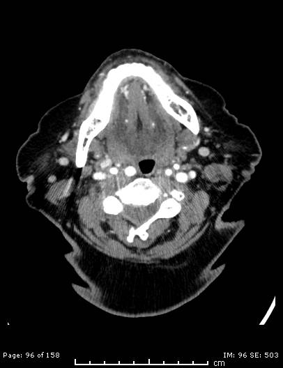 Cerebellar strokes due to intracranial giant cell arteritis (Radiopaedia 68799-78510 CT angiogram 96).jpg