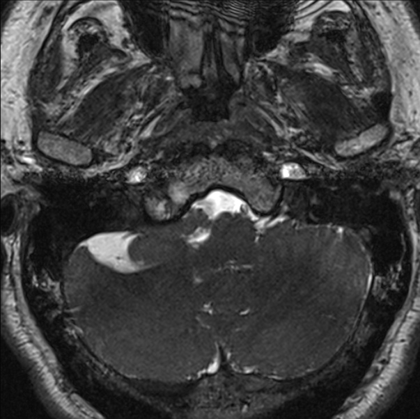 Cerebellopontine angle meningioma (Radiopaedia 24459-24764 I 12).jpg