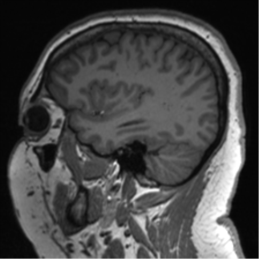 Cerebellopontine angle meningioma (Radiopaedia 48434-53348 Sagittal T1 66).png