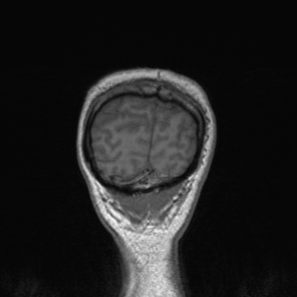 Cerebral abscess (Radiopaedia 24212-24478 Coronal T1 181).jpg