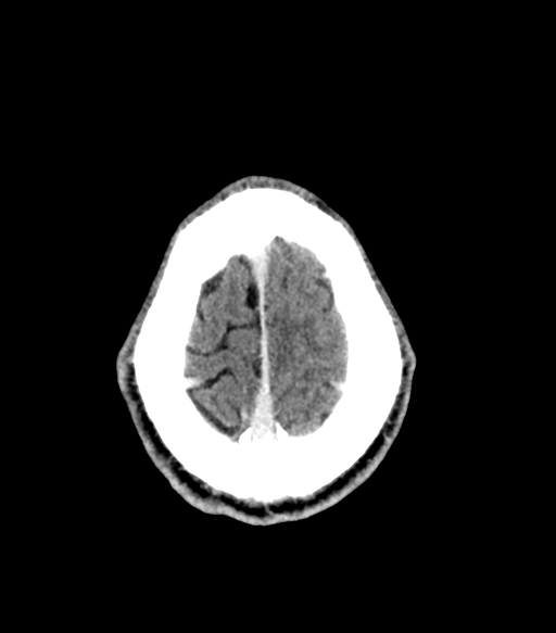 Cerebral abscess (Radiopaedia 57774-64741 Axial C+ delayed 56).png