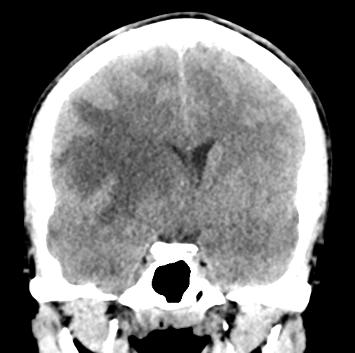 Cerebral abscess (Radiopaedia 60342-68008 Coronal non-contrast 28).png
