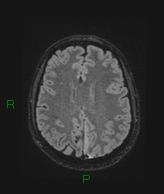 Cerebral abscess and subdural empyema (Radiopaedia 84436-99779 Axial FLAIR 32).jpg