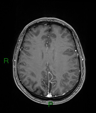 Cerebral abscess and subdural empyema (Radiopaedia 84436-99779 Axial T1 C+ 32).jpg