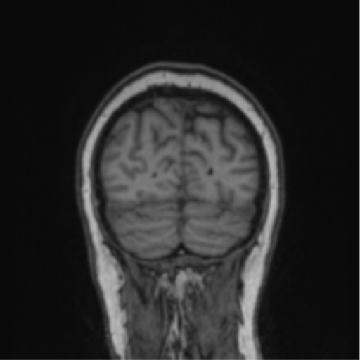 Cerebral abscess from pulmonary arteriovenous malformation (Radiopaedia 86275-102291 Coronal T1 18).png