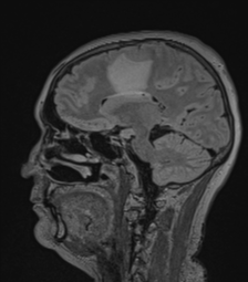 Cerebral abscess from pulmonary arteriovenous malformation (Radiopaedia 86275-102291 Sagittal FLAIR 43).png