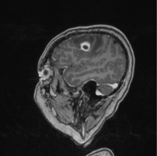 Cerebral abscess from pulmonary arteriovenous malformation (Radiopaedia 86275-102291 Sagittal T1 C+ 62).png