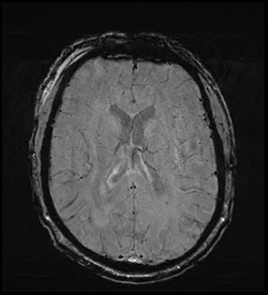 Cerebral abscess with ventriculitis (Radiopaedia 78965-91878 Axial SWI 32).jpg