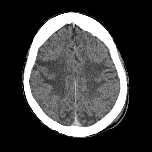 File:Cerebral amyloid angiopathy-related inflammation (Radiopaedia 74836-85848 Axial non-contrast 43).jpg