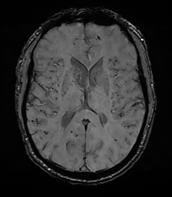 Cerebral amyloid angiopathy (Radiopaedia 46082-50433 Axial SWI 46).png