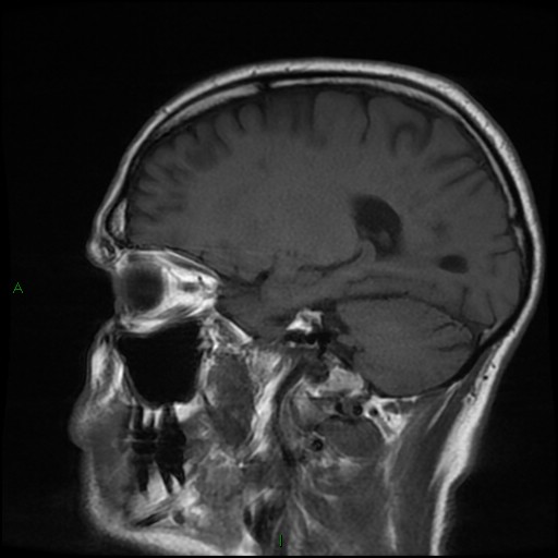 File:Cerebral amyloid angiopathy (Radiopaedia 77506-89664 Coronal T1 10).jpg