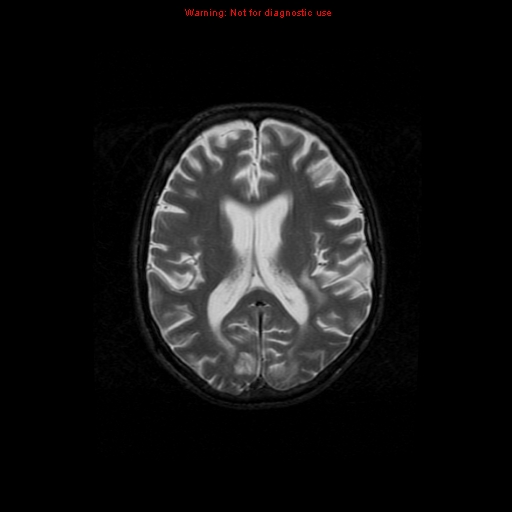 File:Cerebral and orbital tuberculomas (Radiopaedia 13308-13311 Axial T2 13).jpg