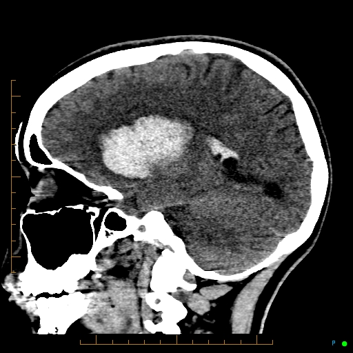 Cerebral arteriovenous malformation (AVM) (Radiopaedia 78162-90706 A 31).jpg