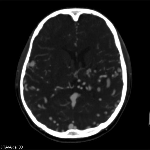 Cerebral arteriovenous malformation (Radiopaedia 28518-28759 B 30).jpg