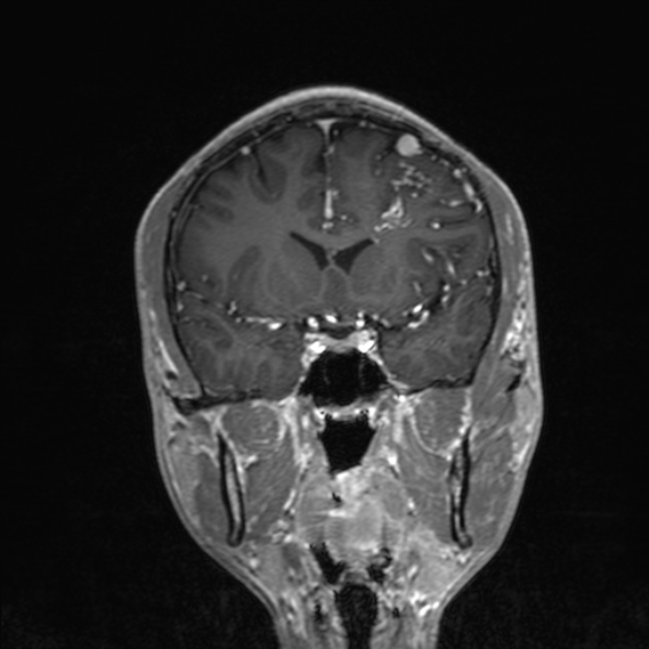 Cerebral arteriovenous malformation (Radiopaedia 30198-30813 F 25).jpg