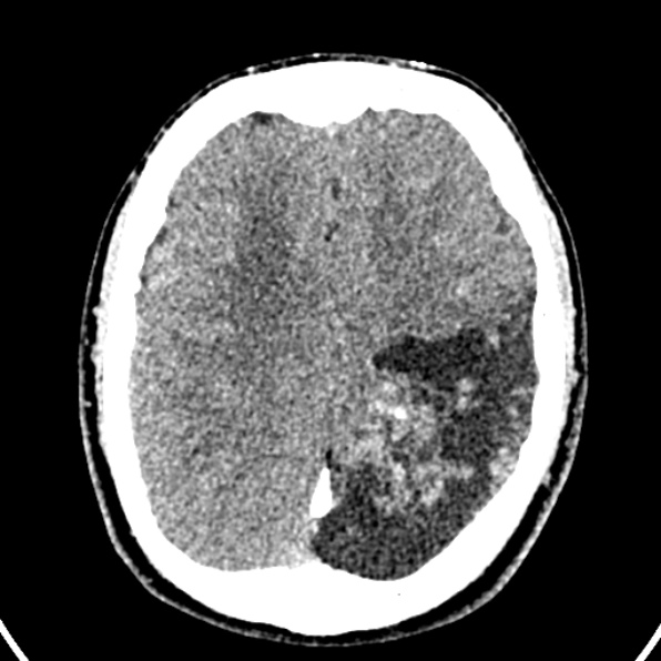 Cerebral arteriovenous malformation (Radiopaedia 37182-39012 Axial non-contrast 33).jpg