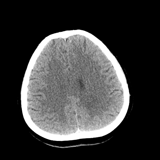 File:Cerebral arteriovenous malformation (Radiopaedia 73830-84645 Axial non-contrast 32).jpg