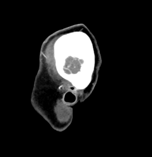 Cerebral arteriovenous malformation (Radiopaedia 73830-84645 D 88).jpg
