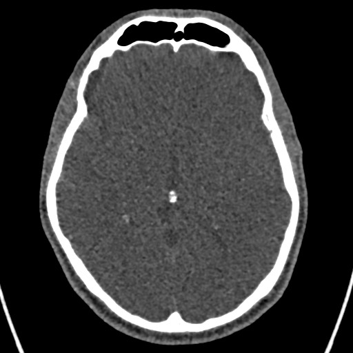 Cerebral arteriovenous malformation (Radiopaedia 78188-90746 Axial non-contrast 85).jpg