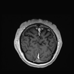 Cerebral arteriovenous malformation (Radiopaedia 84015-99245 Coronal T1 C+ 152).jpg