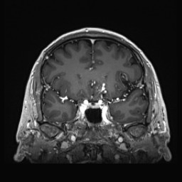 Cerebral arteriovenous malformation (Radiopaedia 84015-99245 Coronal T1 C+ 60).jpg