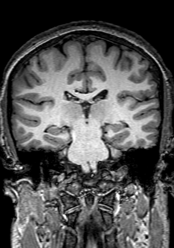 File:Cerebral arteriovenous malformation at posterior body of corpus callosum (Radiopaedia 74111-84925 Coronal T1 195).jpg