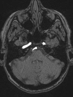 Cerebral arteriovenous malformation with hemorrhage (Radiopaedia 34422-35737 Axial MRA 17).png