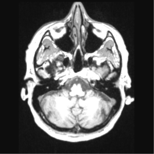 File:Cerebral arteriovenous malformation with hemorrhage (Radiopaedia 34422-35737 Axial T1 17).png