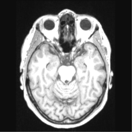 Cerebral arteriovenous malformation with hemorrhage (Radiopaedia 34422-35737 Axial T1 29).png