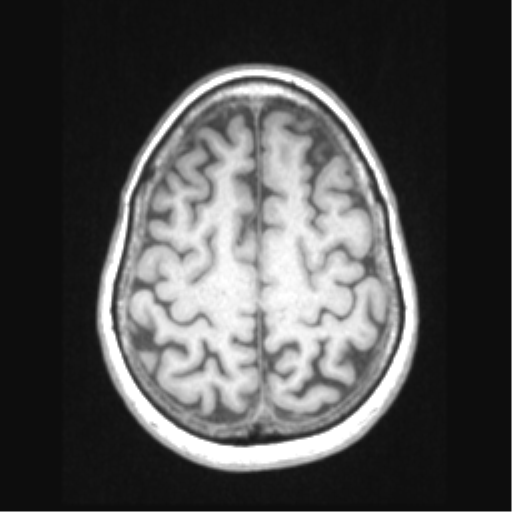File:Cerebral arteriovenous malformation with hemorrhage (Radiopaedia 34422-35737 Axial T1 60).png