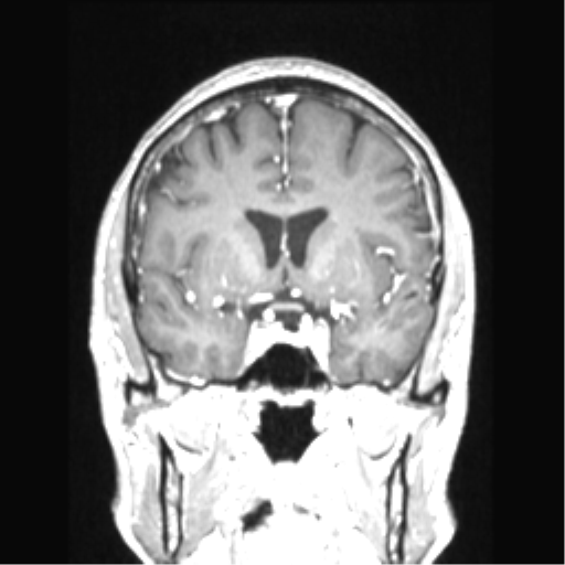 Cerebral arteriovenous malformation with hemorrhage (Radiopaedia 34422-35737 Coronal T1 C+ 57).png