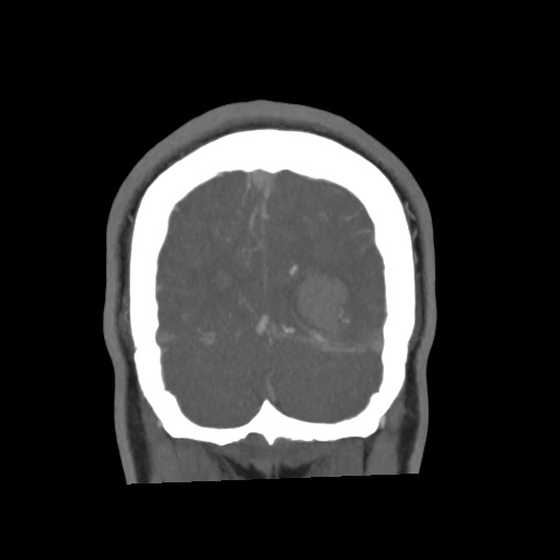 Cerebral arteriovenous malformation with lobar hemorrhage (Radiopaedia 35598-57216 C 81).jpg