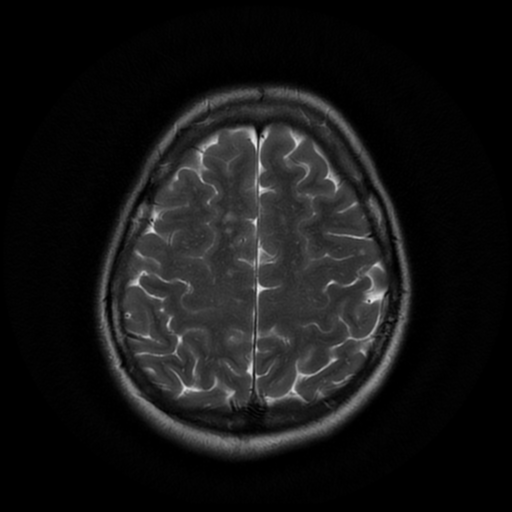 File:Cerebral autosomal dominant arteriopathy with subcortical infarcts and leukoencephalopathy (CADASIL) (Radiopaedia 41018-43768 Ax T2 PROP 16).png
