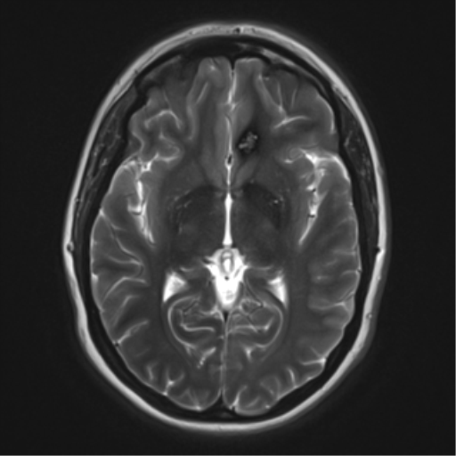 File:Cerebral cavernoma and development venous anomaly (Radiopaedia 37603-39482 Axial T2 11).png