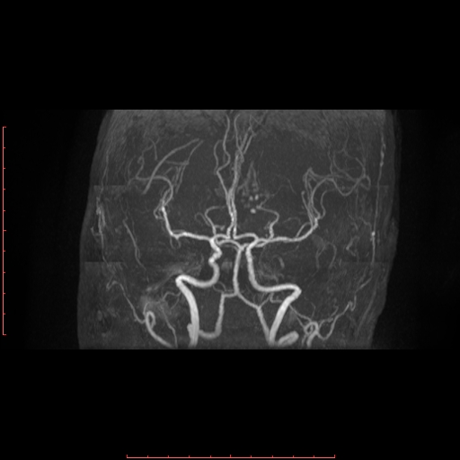 File:Cerebral cavernous malformation (Radiopaedia 26177-26306 MRA 10).jpg