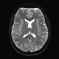Cerebral cavernous venous malformation (Radiopaedia 70008-80021 Axial DWI 18).jpg