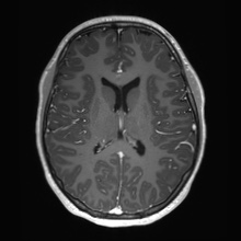 Cerebral cavernous venous malformation (Radiopaedia 70008-80021 Axial T1 C+ 43).jpg