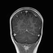 Cerebral cavernous venous malformation (Radiopaedia 70008-80021 Coronal T1 C+ 15).jpg