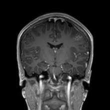 Cerebral cavernous venous malformation (Radiopaedia 70008-80021 Coronal T1 C+ 32).jpg