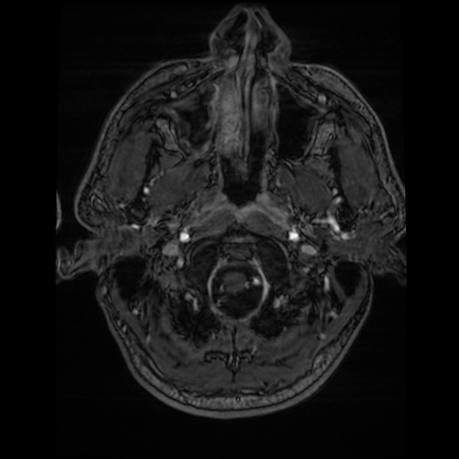 Cerebral cavernous venous malformation (Zabramski type II) (Radiopaedia 85511-101198 Axial T1 C+ fat sat 78).jpg