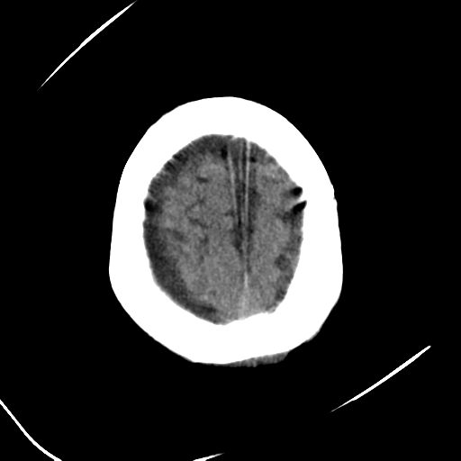 File:Cerebral contusions, subarachnoid hemorrhage and subdural hygromas (Radiopaedia 55399-61830 Axial non-contrast 27).png